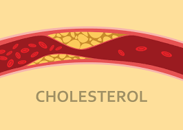 کلسترول بالا - high cholesterol