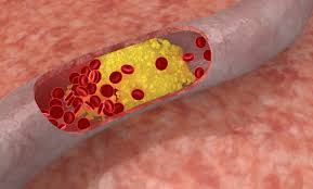 تری‌گلیسرید بالا - high triglyceride